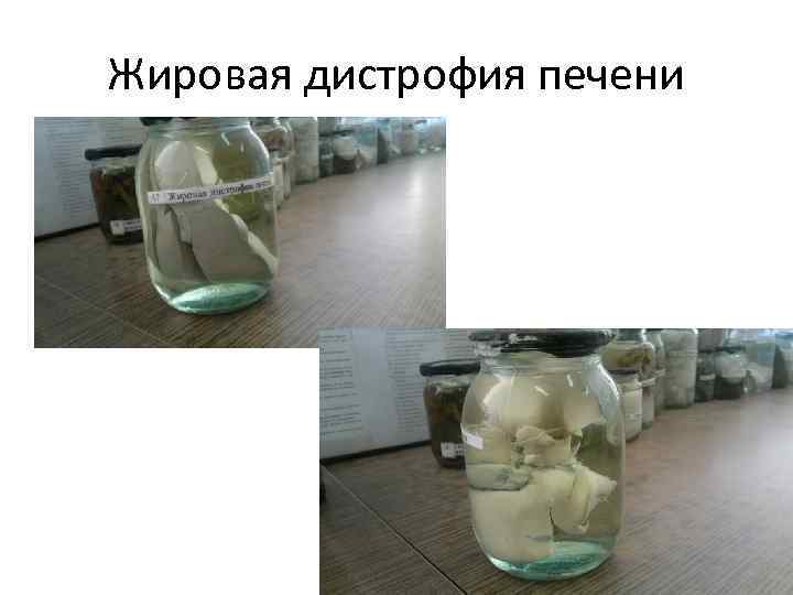 Жировая дистрофия печени 