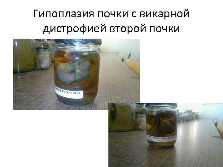 Гипоплазия почки с викарной дистрофией второй почки 