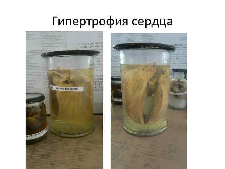 Гипертрофия сердца 