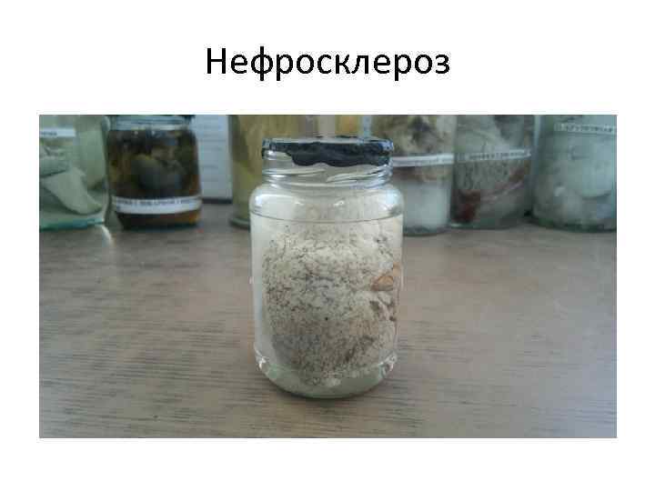 Нефросклероз 