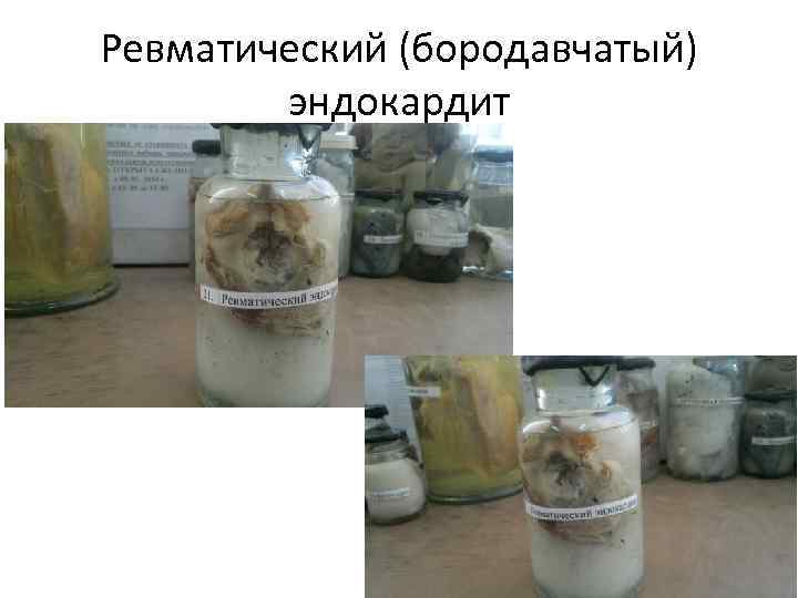 Ревматический (бородавчатый) эндокардит 