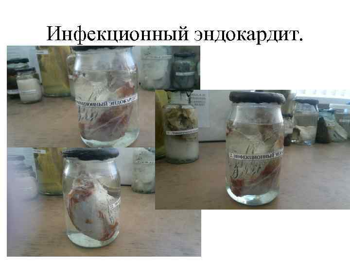 Инфекционный эндокардит. 