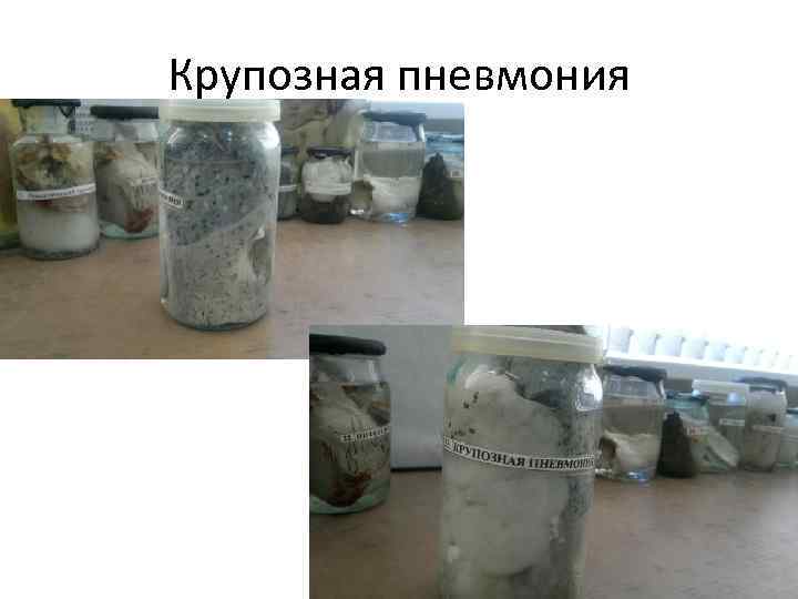 Крупозная пневмония 