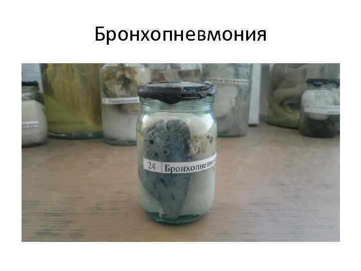 Бронхопневмония 