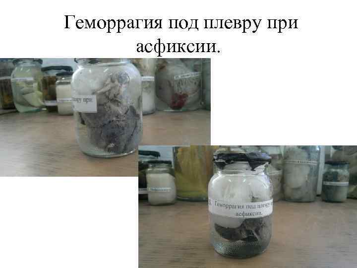 Геморрагия под плевру при асфиксии. 