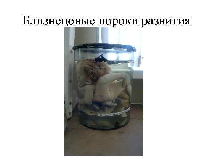 Близнецовые пороки развития 