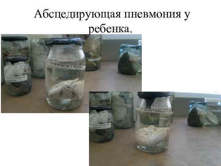 Абсцедирующая пневмония у ребенка. 