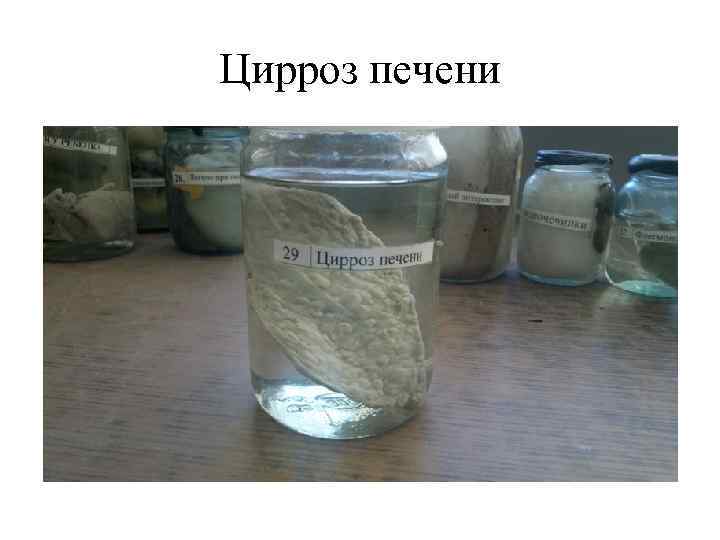 Цирроз печени 