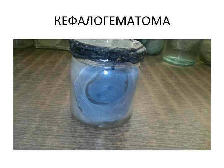 КЕФАЛОГЕМАТОМА 