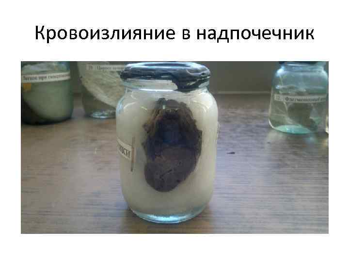 Кровоизлияние в надпочечник 