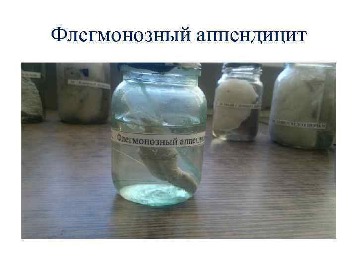 Флегмонозный аппендицит 