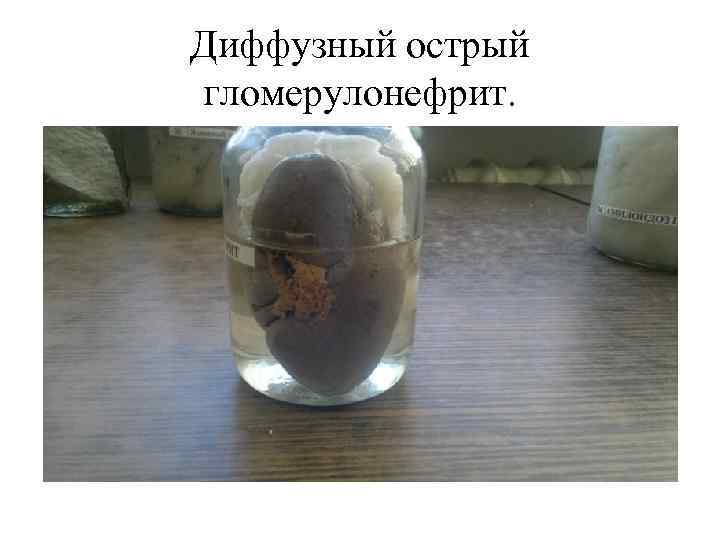 Диффузный острый гломерулонефрит. 