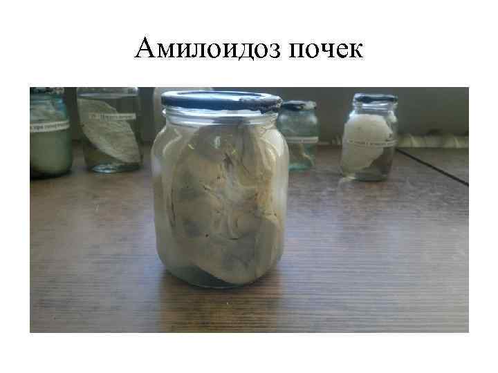 Амилоидоз почек 