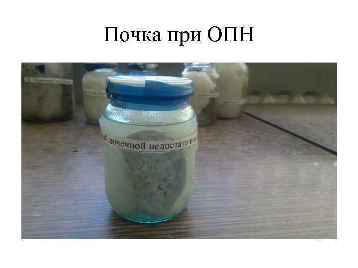 Почка при ОПН 
