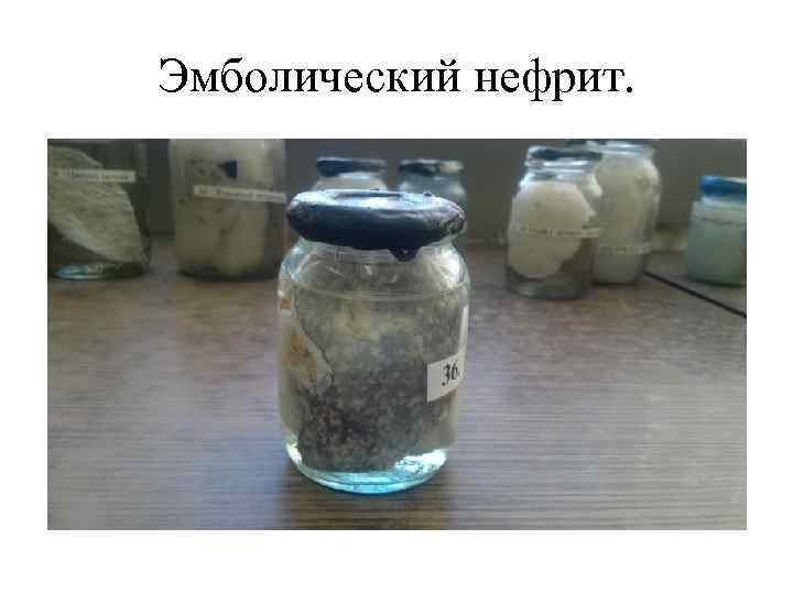 Эмболический нефрит. 