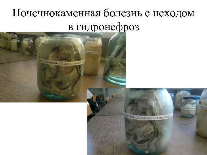 Почечнокаменная болезнь с исходом в гидронефроз 