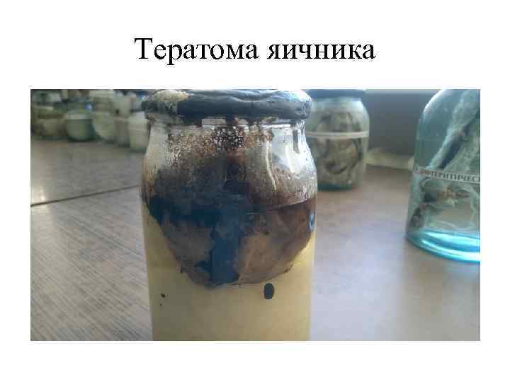 Тератома яичника 