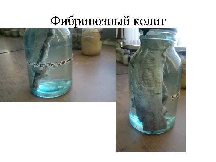 Фибринозный колит 