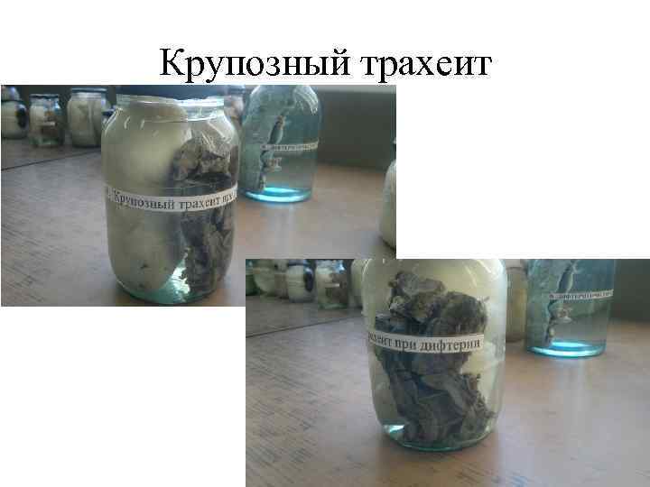 Крупозный трахеит 