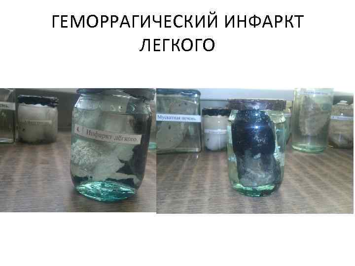 ГЕМОРРАГИЧЕСКИЙ ИНФАРКТ ЛЕГКОГО 