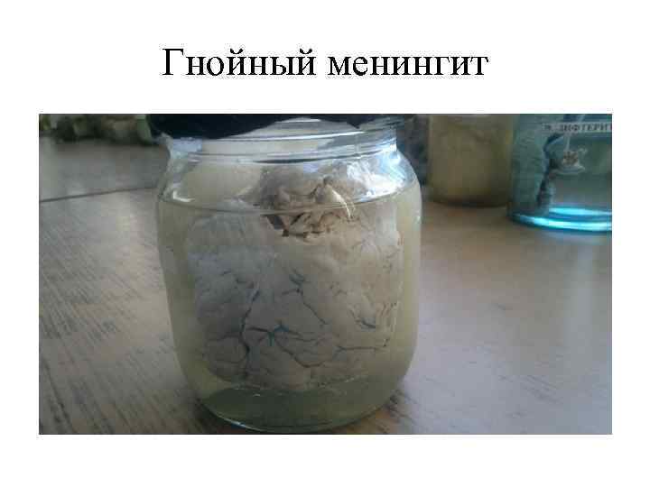 Гнойный менингит 