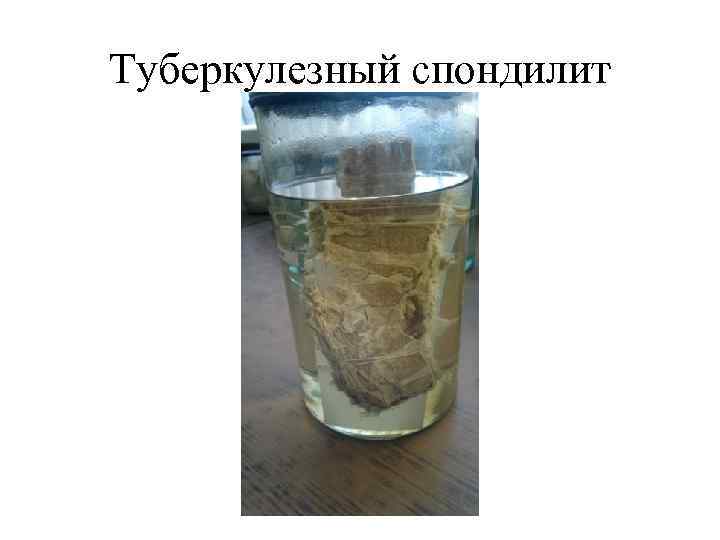 Туберкулезный спондилит 