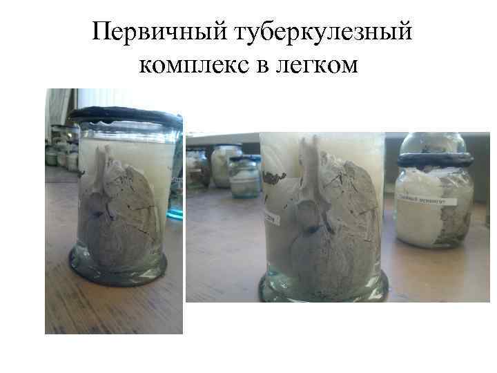 Первичный туберкулезный комплекс в легком 