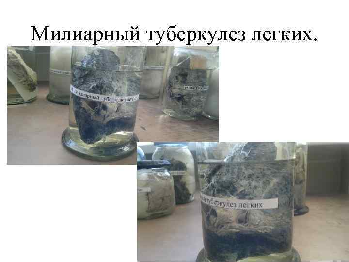 Милиарный туберкулез легких. 