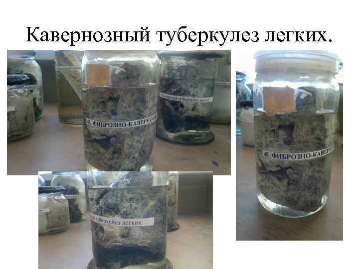 Кавернозный туберкулез легких. 