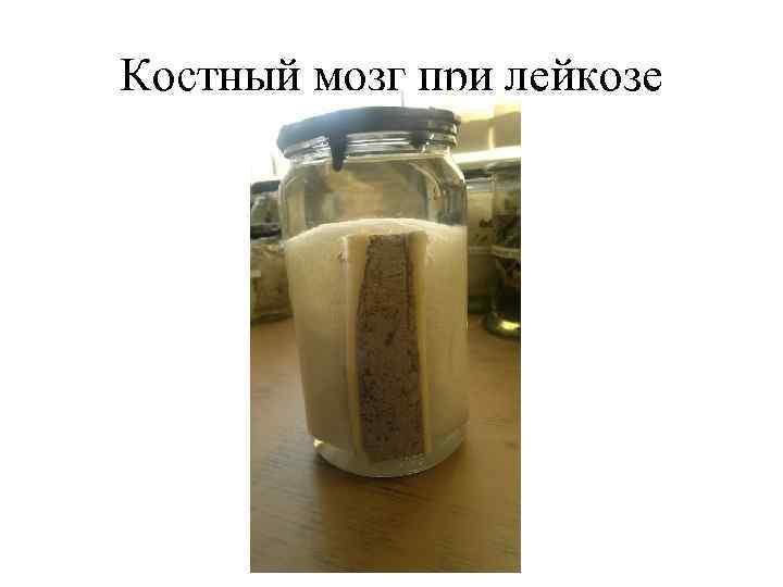 Костный мозг при лейкозе 