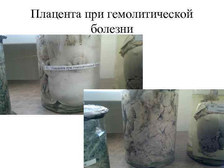 Плацента при гемолитической болезни 