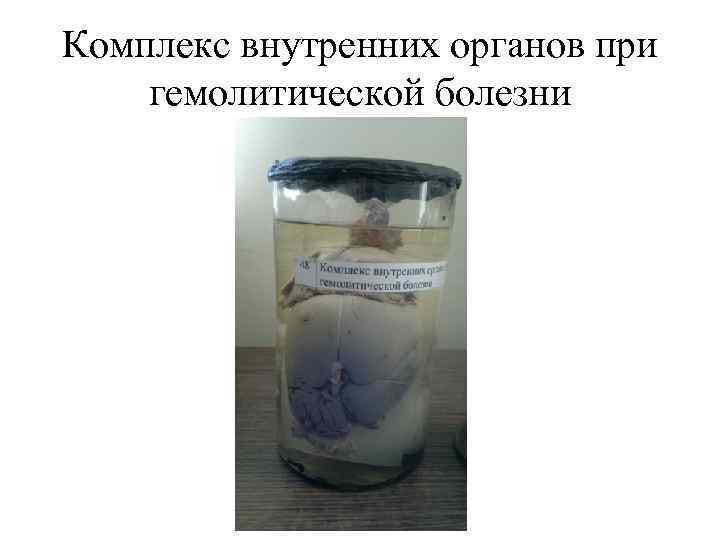 Комплекс внутренних органов при гемолитической болезни 