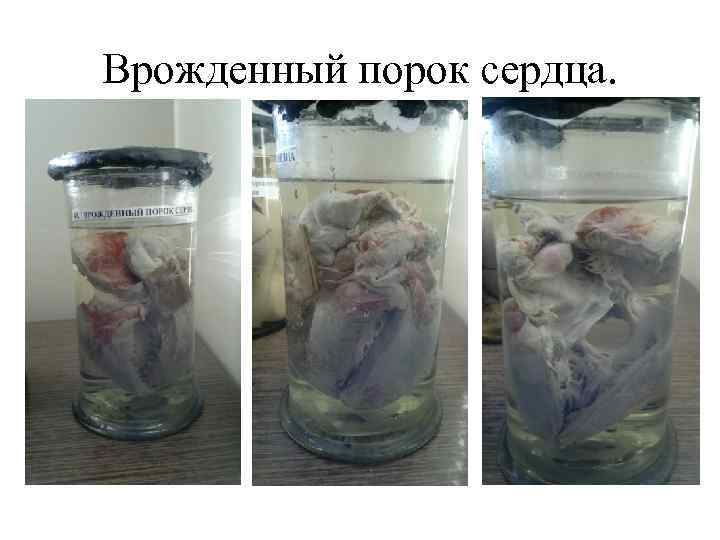 Врожденный порок сердца. 