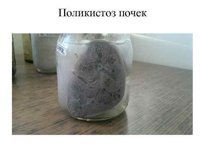 Поликистоз почек 