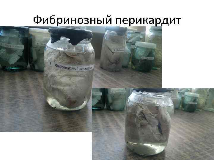 Фибринозный перикардит 