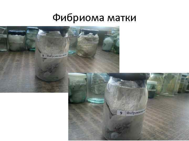 Фибриома матки 