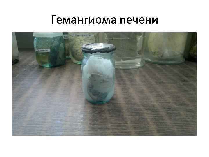 Гемангиома печени 