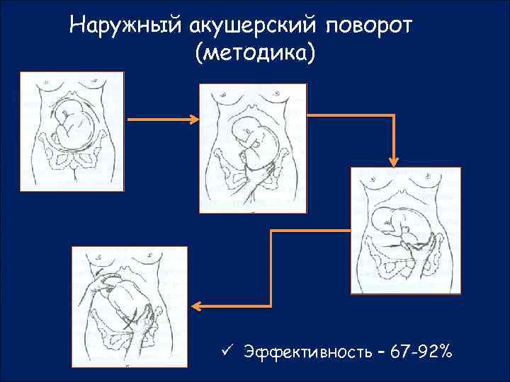 Наружный акушерский поворот (методика) ü Эффективность – 67 -92% 