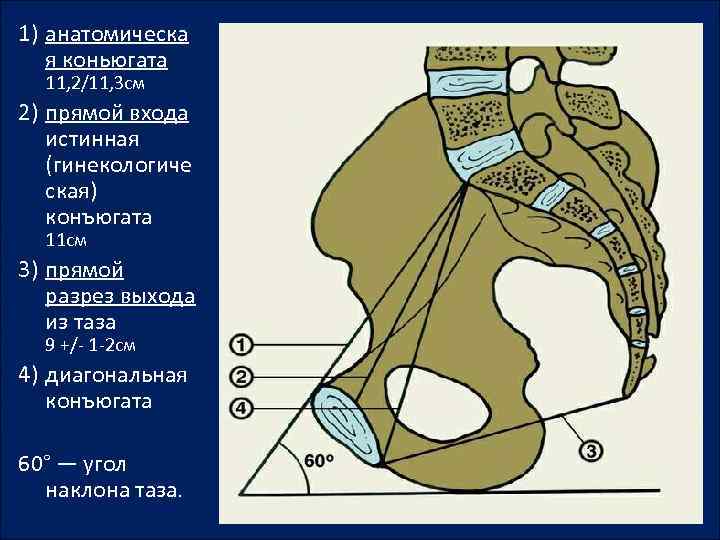 1) анатомическа я коньюгата 11, 2/11, 3 см 2) прямой входа истинная (гинекологиче ская)