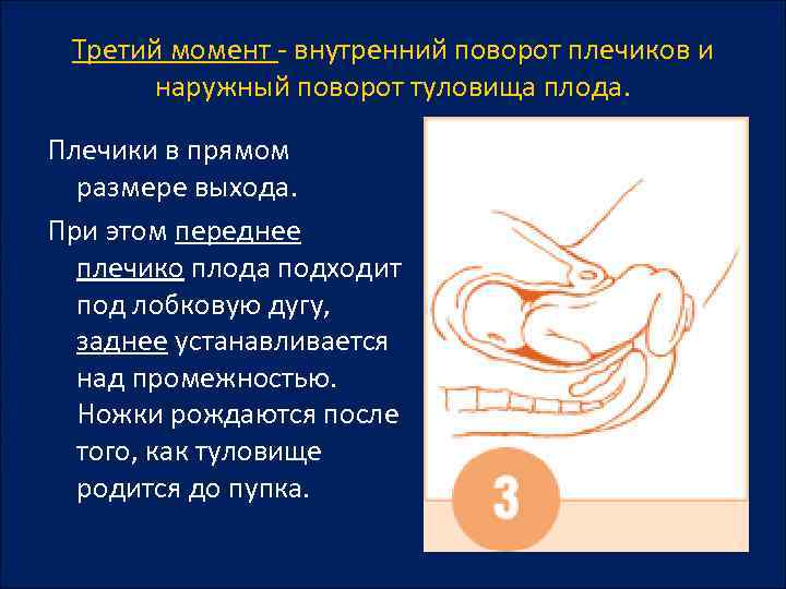 Третий момент - внутренний поворот плечиков и наружный поворот туловища плода. Плечики в прямом