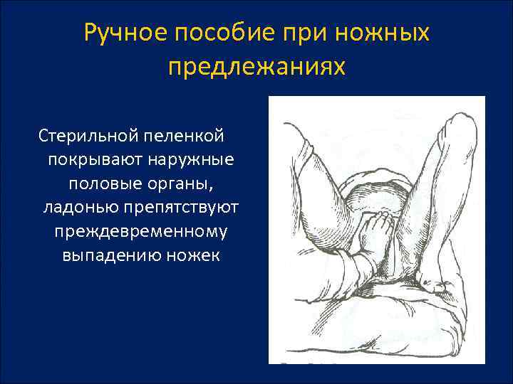Ручное пособие при ножных предлежаниях Стерильной пеленкой покрывают наружные половые органы, ладонью препятствуют преждевременному