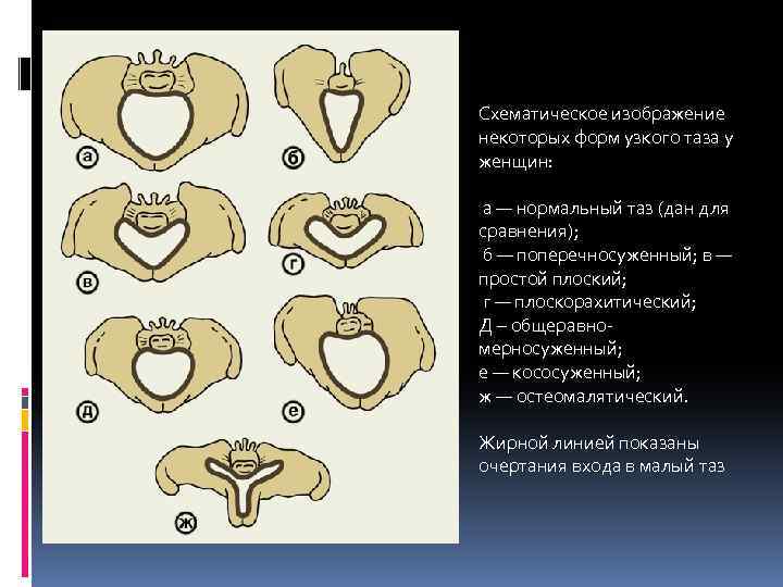 Схематическое изображение некоторых форм узкого таза у женщин: а — нормальный таз (дан для
