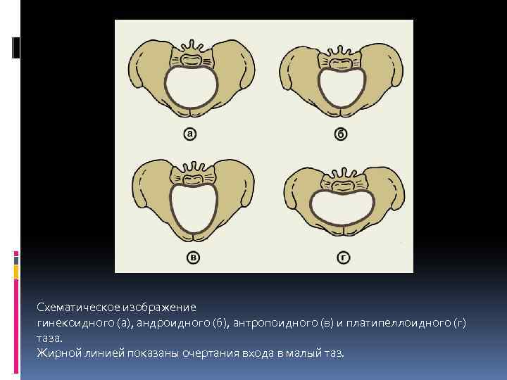 Схематическое изображение гинекоидного (а), андроидного (б), антропоидного (в) и платипеллоидного (г) таза. Жирной линией