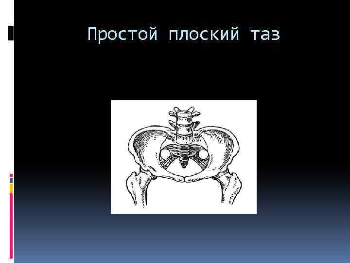 Презентация аномалии костного таза