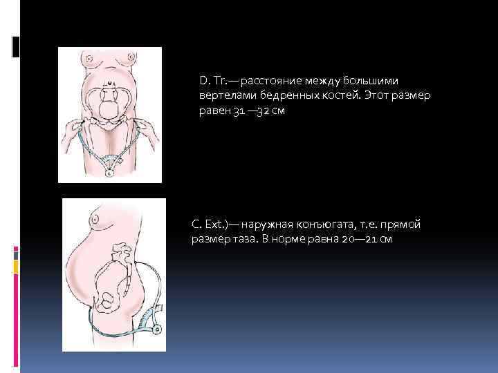 D. Tr. — расстояние между большими вертелами бедренных костей. Этот размер равен 31 —