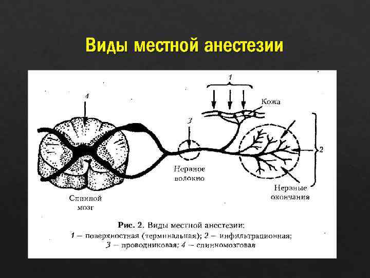 Виды местной анестезии 