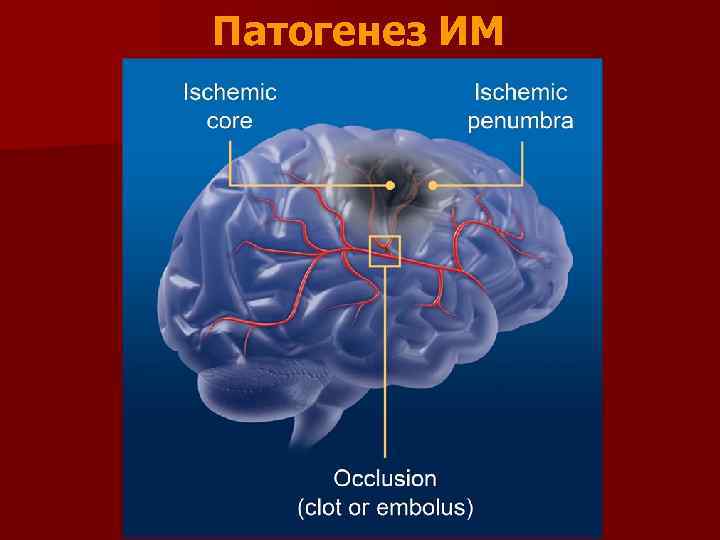 Патогенез ИМ 