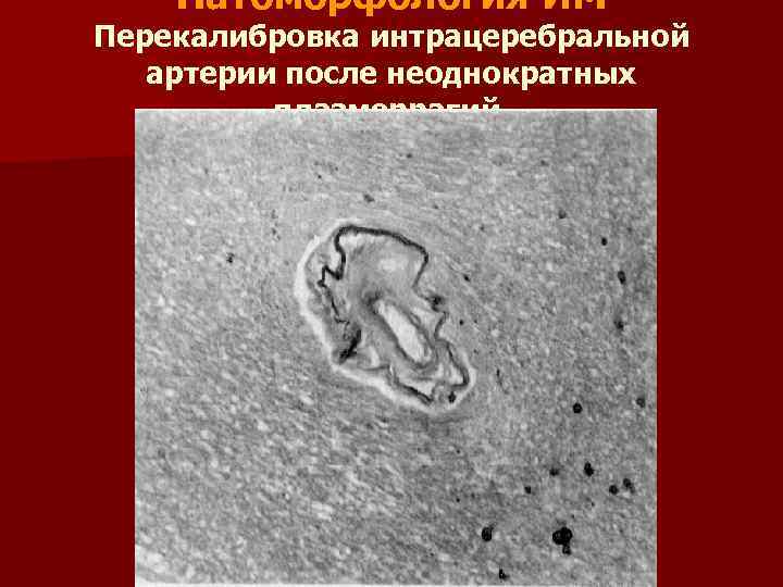 Патоморфология ИМ Перекалибровка интрацеребральной артерии после неоднократных плазморрагий. 