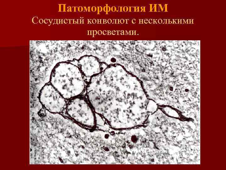 Патоморфология ИМ Сосудистый конволют с несколькими просветами. 