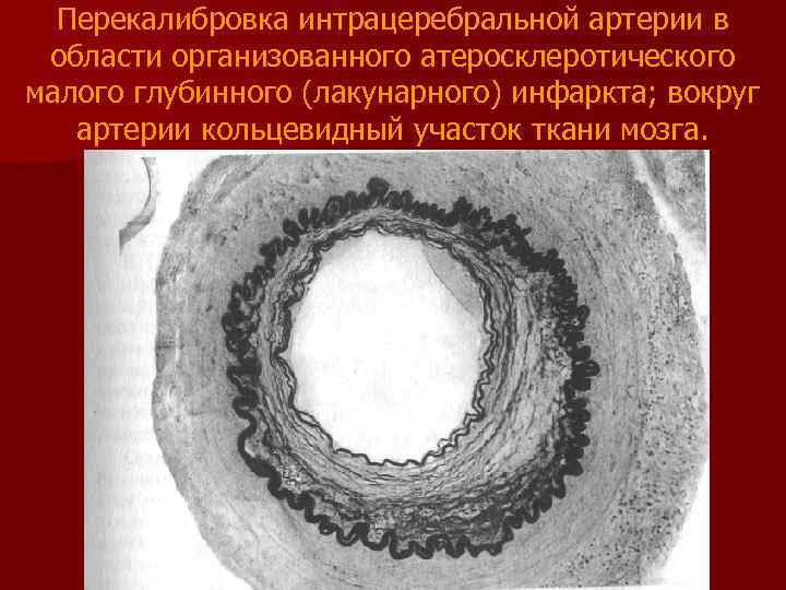 Перекалибровка интрацеребральной артерии в области организованного атеросклеротического малого глубинного (лакунарного) инфаркта; вокруг артерии кольцевидный